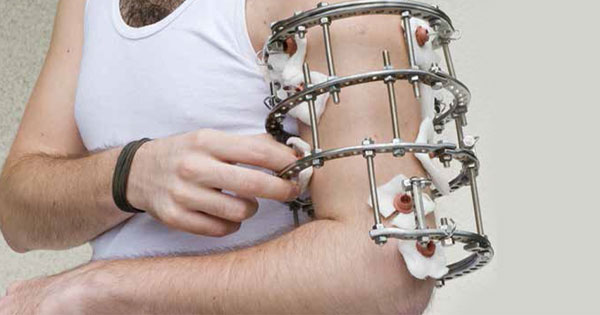 Limb reconstruction surgery