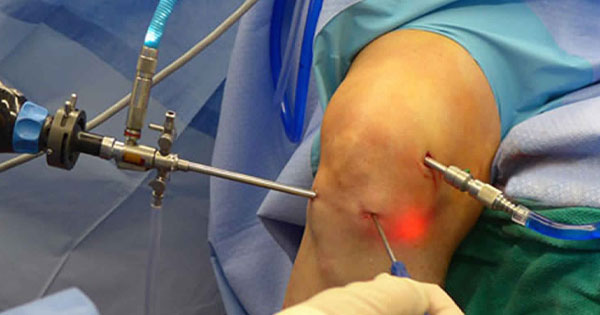 Everything about Knee arthroscopy