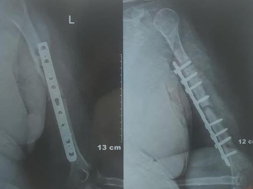 Non union fracture treatment