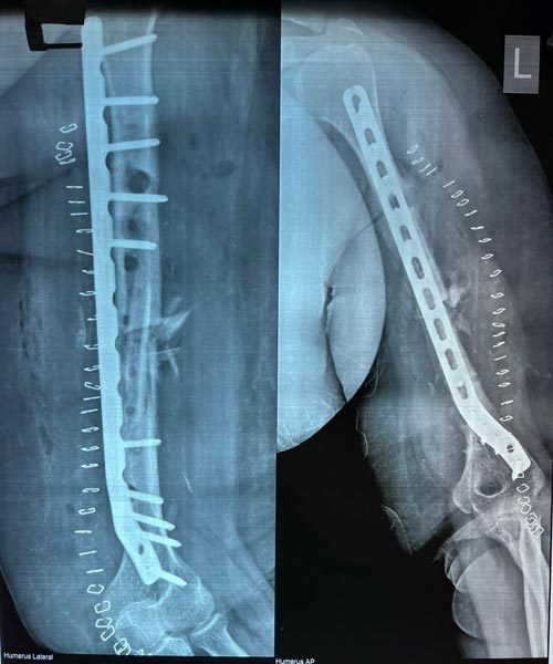 Non union fracture treatment